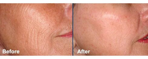 Pelle del viso prima e dopo il ringiovanimento laser
