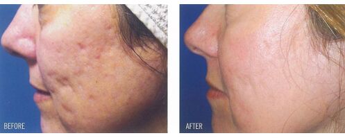 Prima e dopo l'utilizzo del dispositivo laser sulla pelle con cicatrici